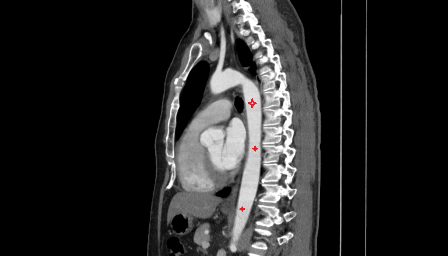 Thoracic aorta  ct sag  anatomy  image-img-00000-00000