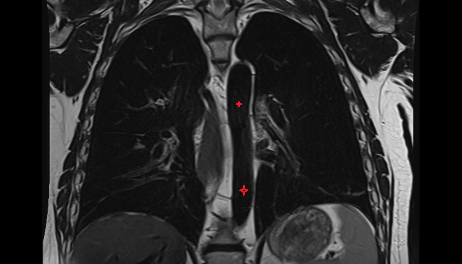 Thoracic aorta  mri coronal  anatomy  image-img-00000-00000