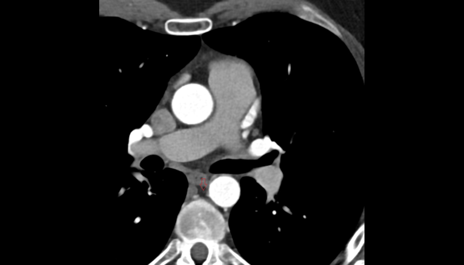 Thoracic duct  CT axial image -img-00000-00000