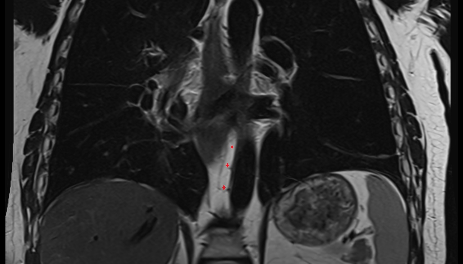 Thoracic duct  MRI  CORONAL  image -img-00000-00000