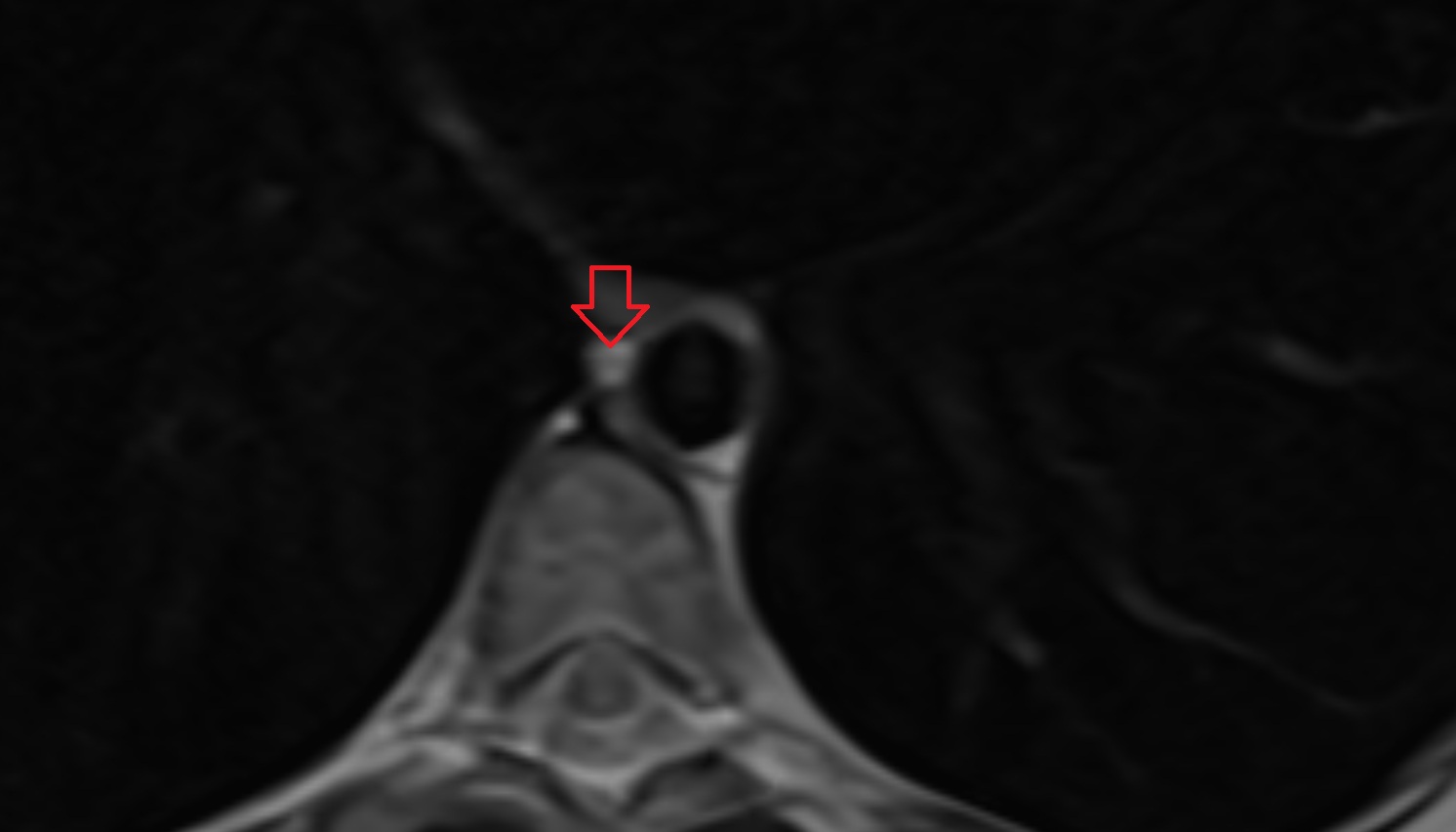 Thoracic duct  MRI  axial image -img-00000-00000