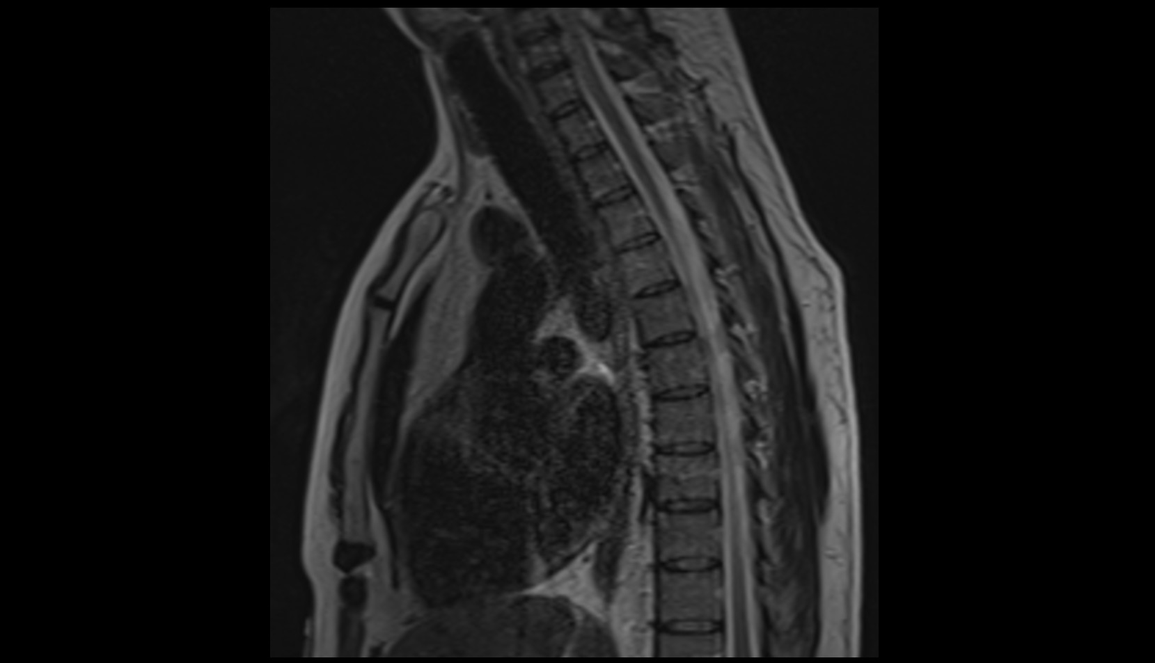 Thoracic part of esophagus