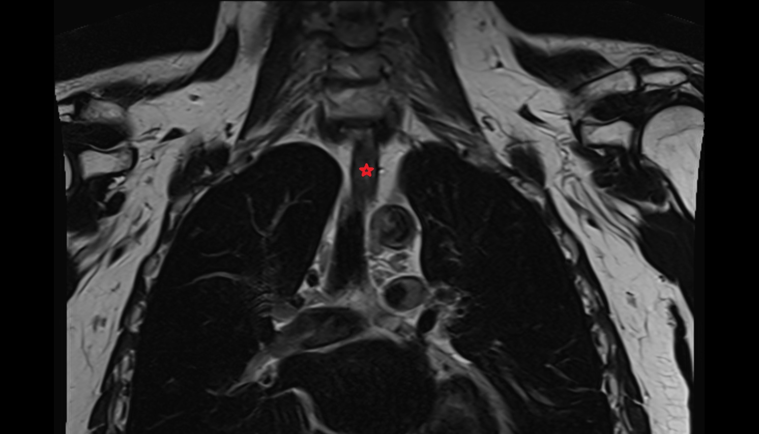 Thoracic part of esophagus MRI coronal  image -img-00000-00000