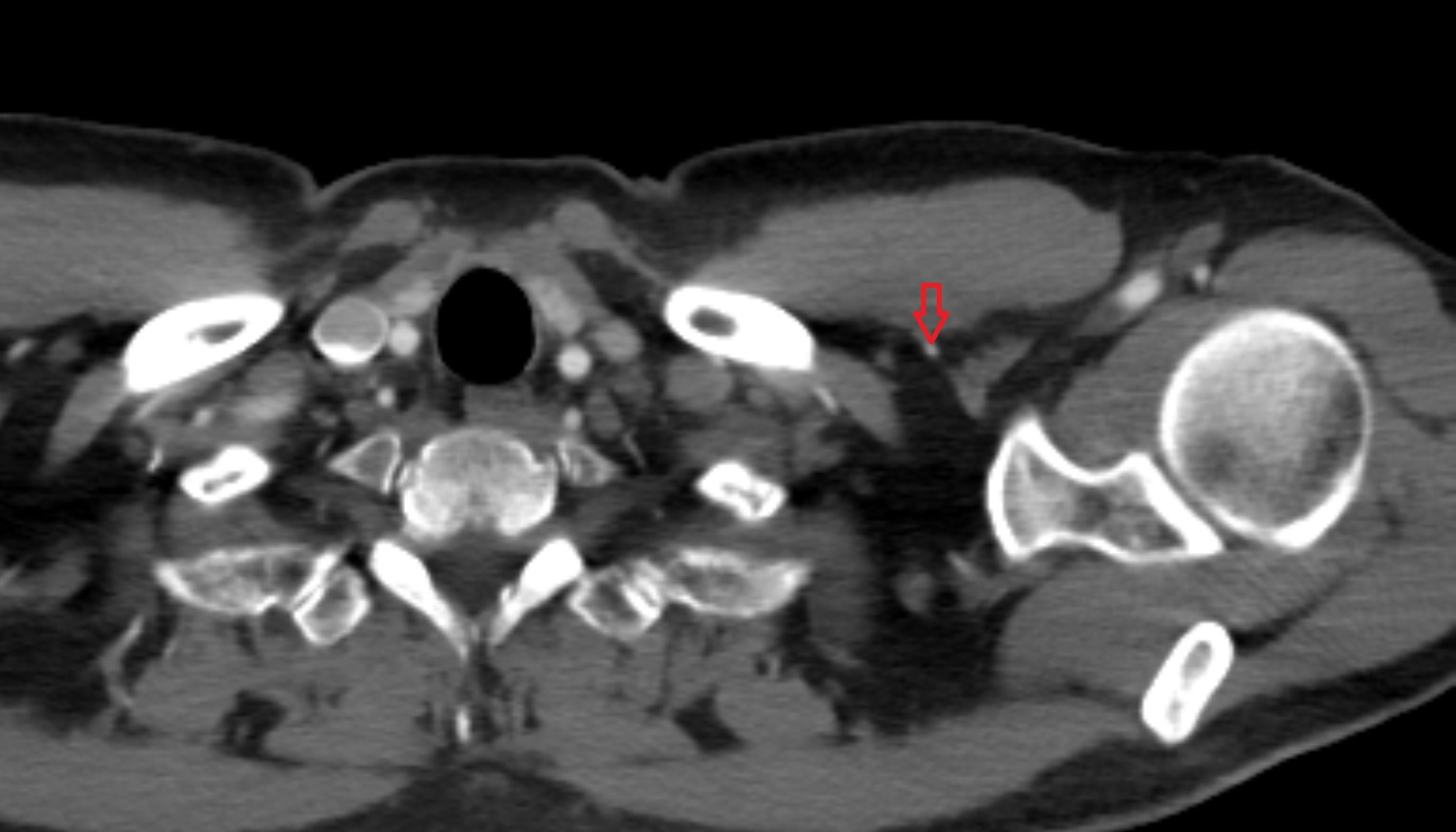 Thoracoacromial artery  anatomy CT axial  image -img-00000-00000