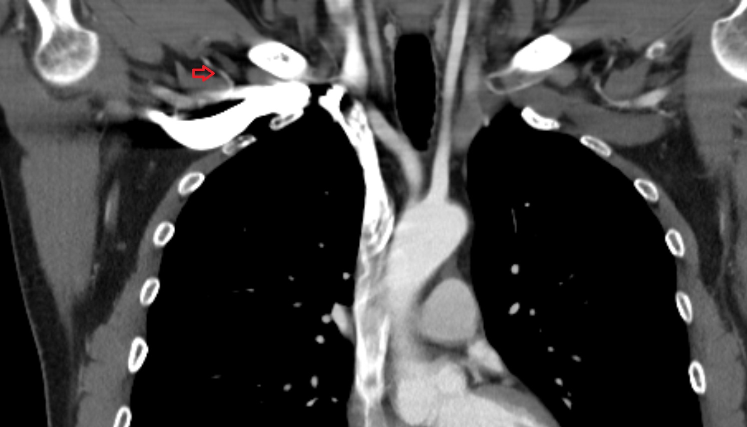 Thoracoacromial artery  anatomy CT coronal  image -img-00000-00000