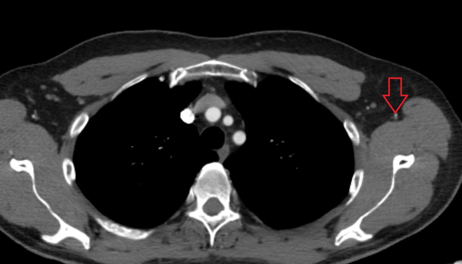 Thoracodorsal artery  anatomy CT axial  image -img-00000-00000