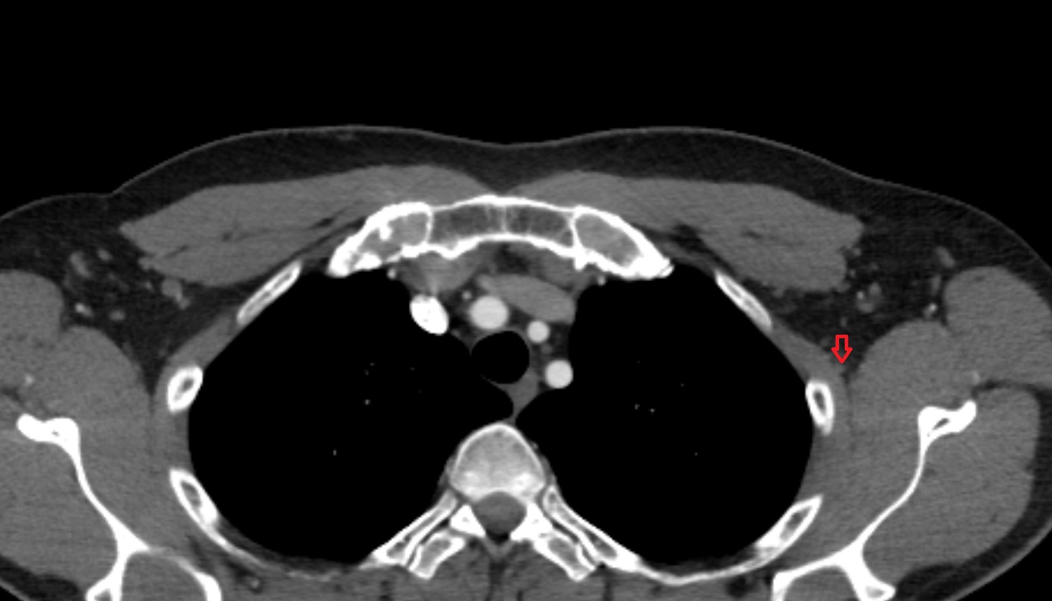 Thoracodorsal vein  CT axial  image -img-00000-00000