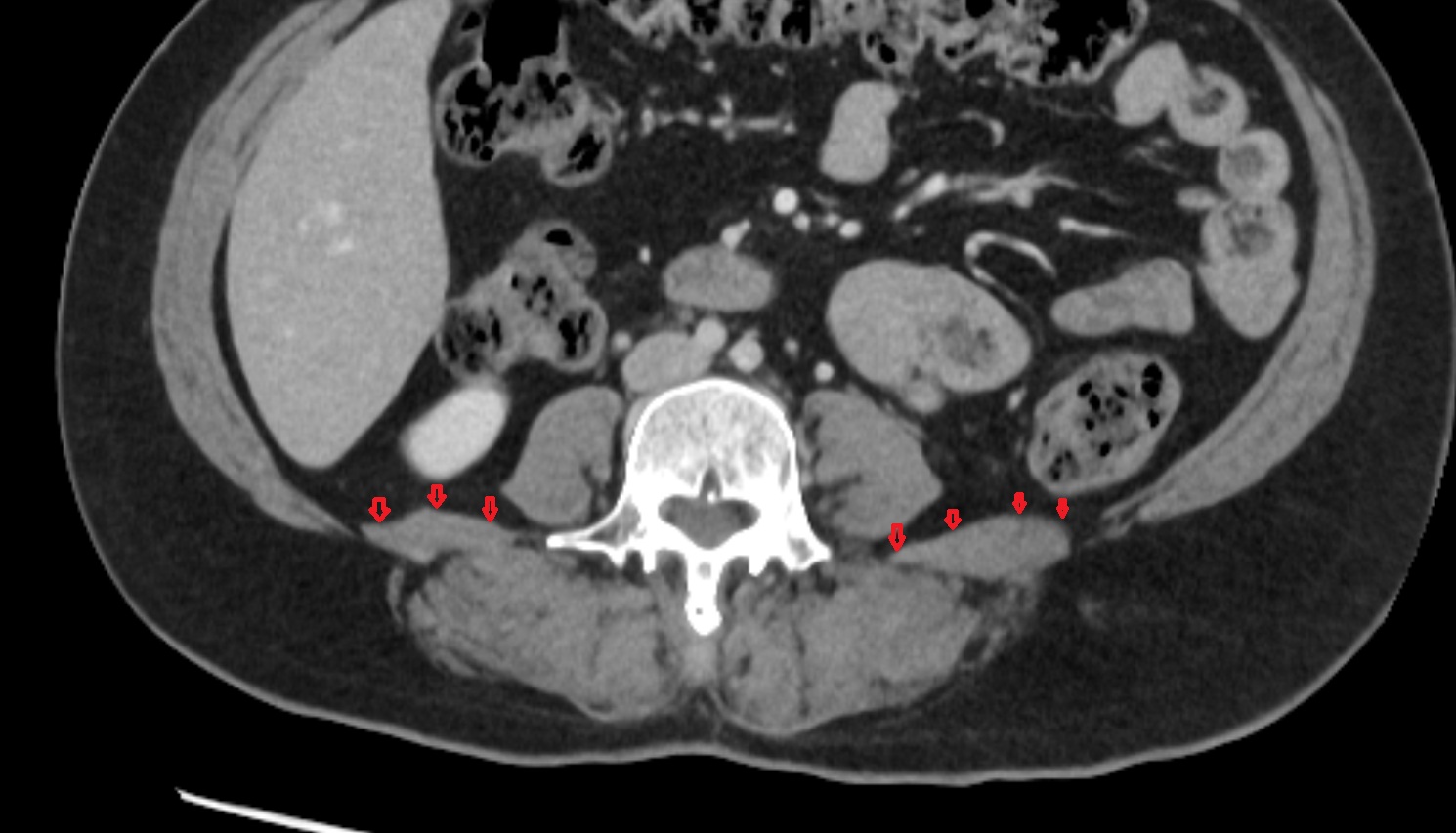 Thoracolumbar Fascia (Anterior Layer)  CT AXIAL   anatomy  image-img-00000-00000