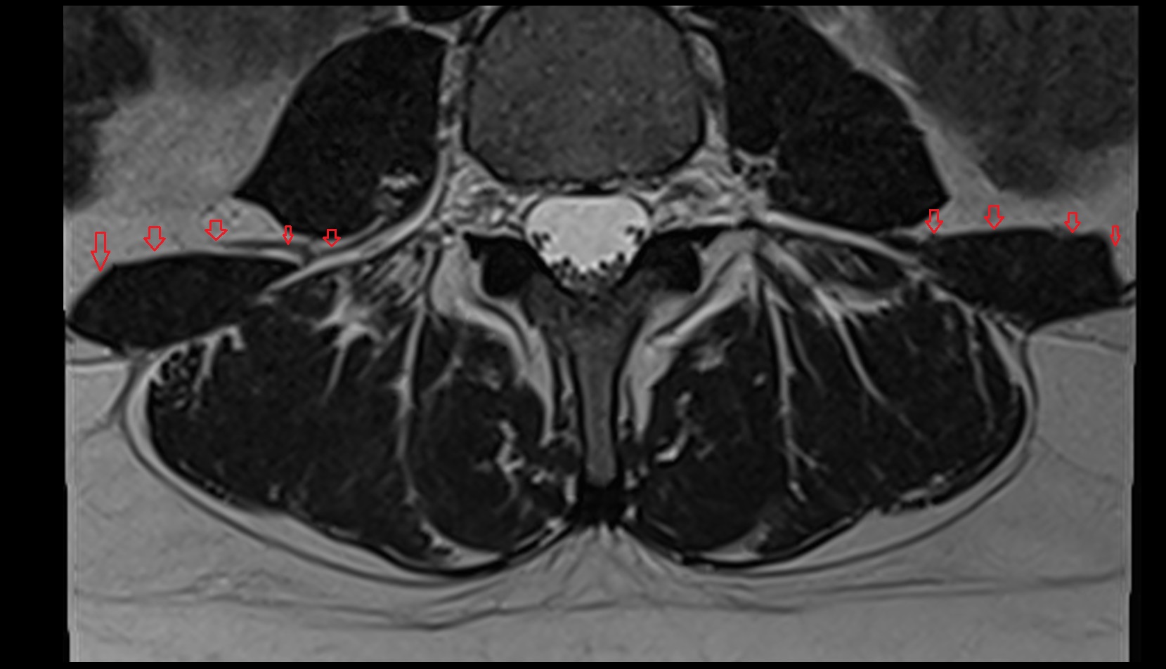Thoracolumbar Fascia (Anterior Layer) axial MRI image