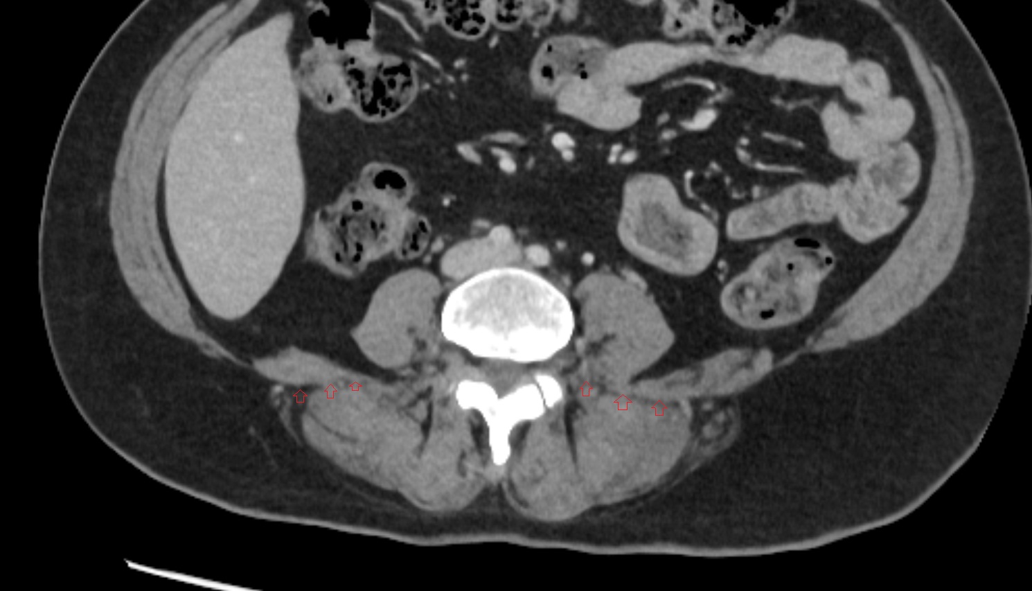 Thoracolumbar fascia (middle layer)  CT AXIAL   anatomy  image-img-00000-00000
