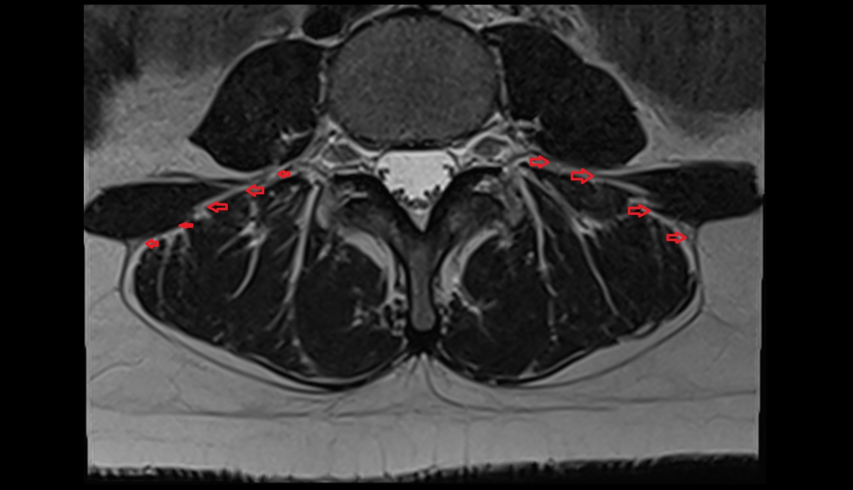 Thoracolumbar fascia (middle layer) MRI axial image