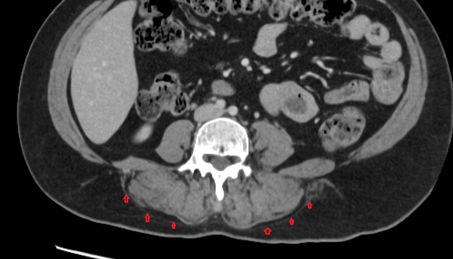 Thoracolumbar fascia (posterior layer)  CT AXIAL   anatomy  image-img-00000-00000
