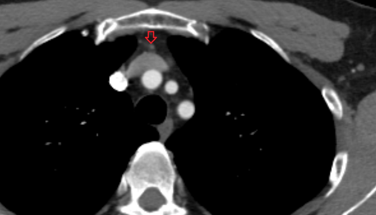 Thymic veins  anatomy CT axial  image -img-00000-00000