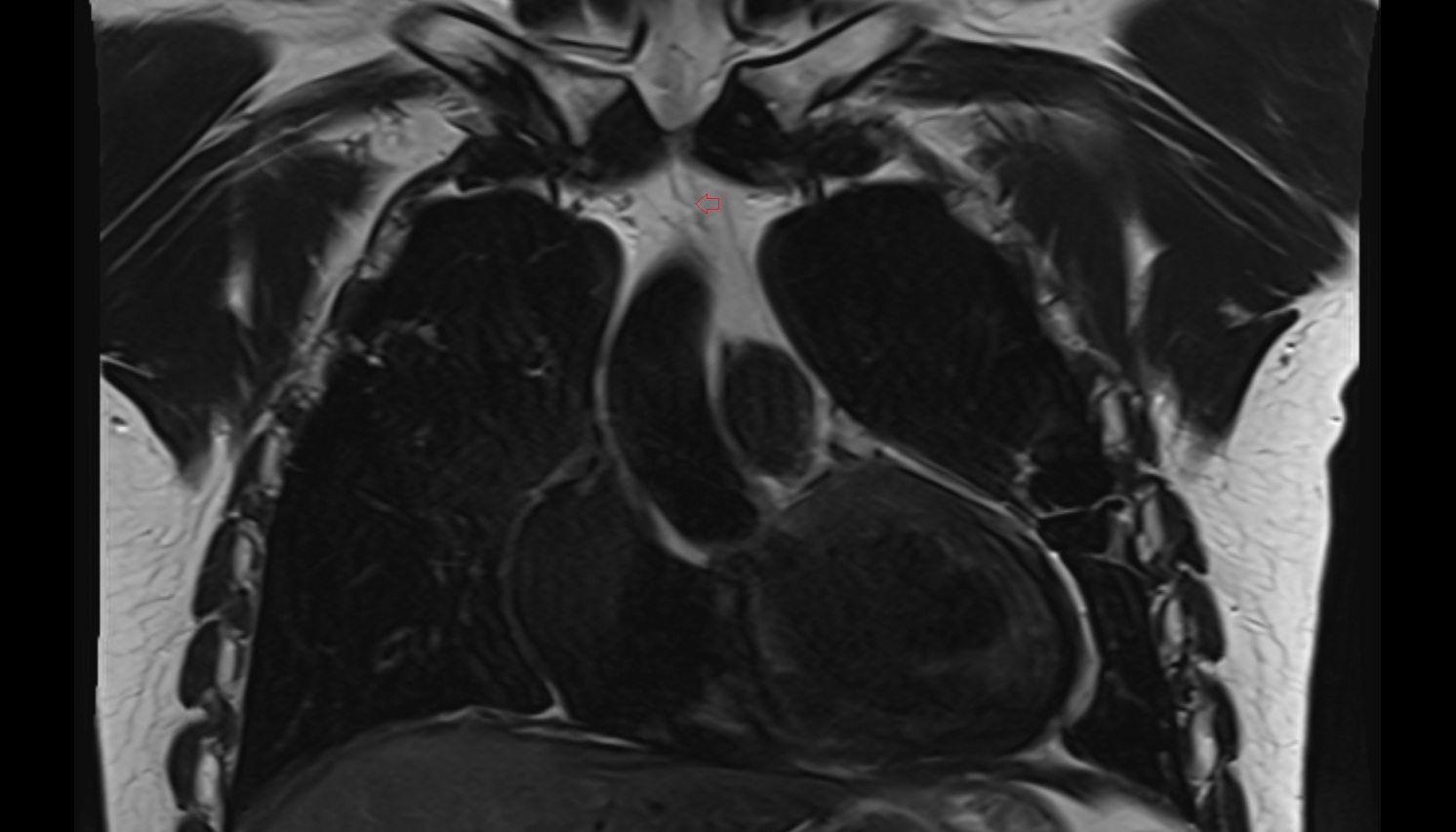 Thymic veins  anatomy MRI coronal  image -img-00000-00000