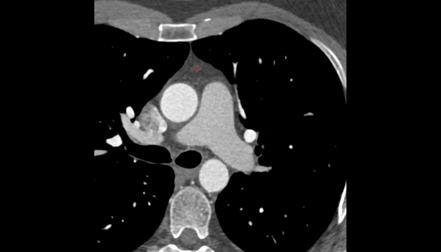 Thymus  anatomy ct axial  image -img-00000-00000