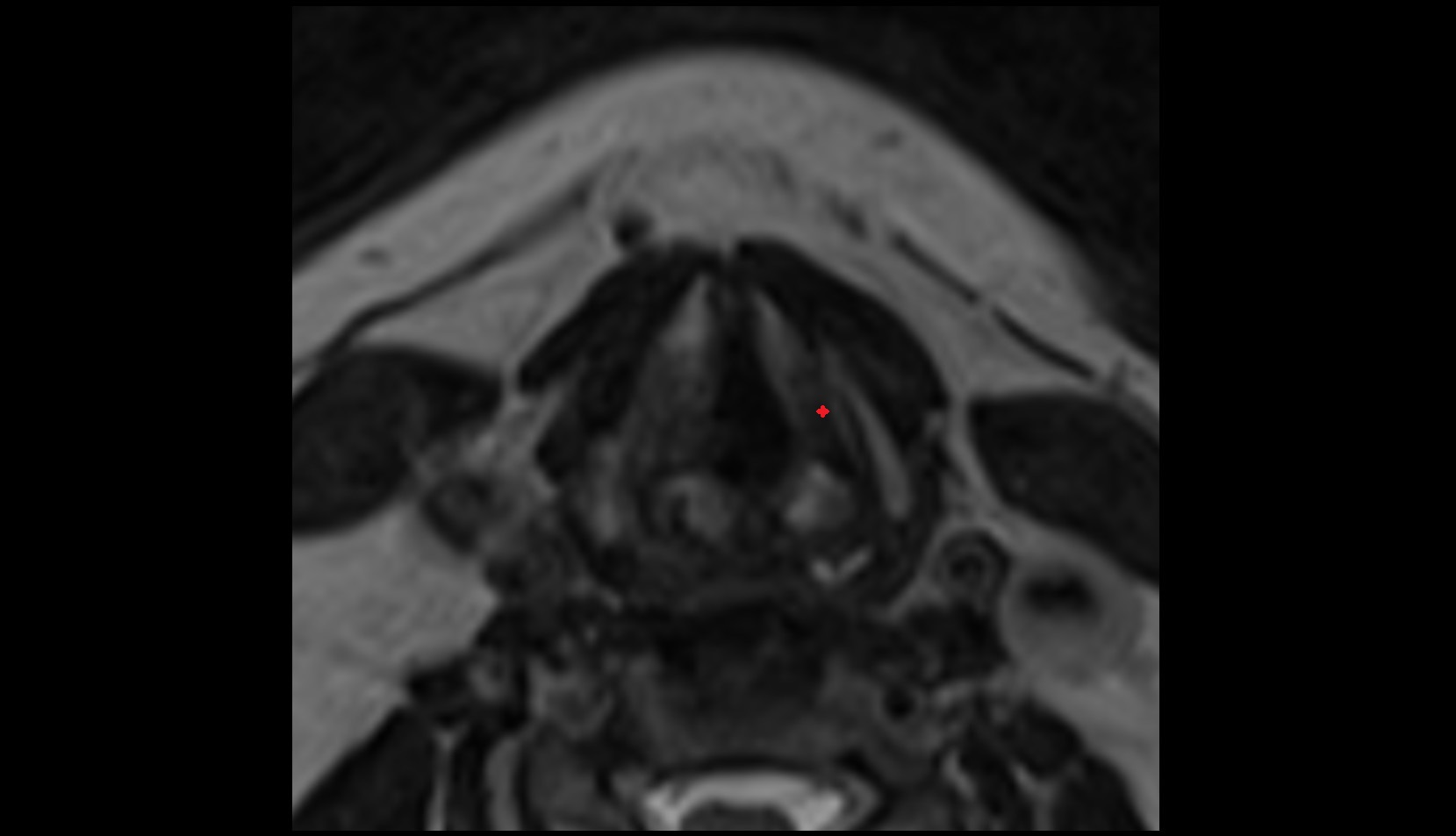 Thyroarytenoid muscle mri axial image