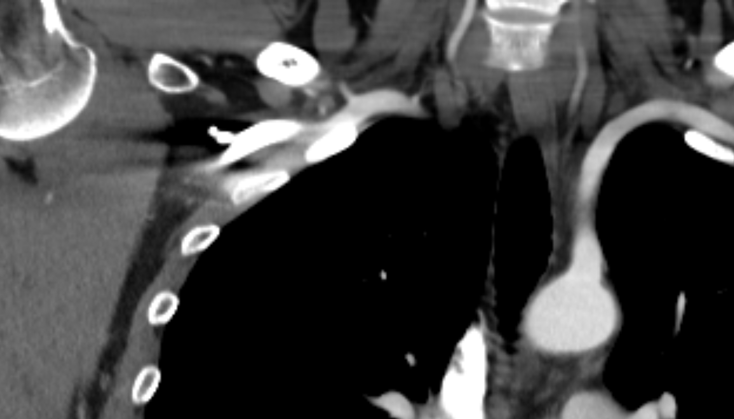 Thyrocervical trunk anatomy CT coronal  image -img-00000-00000