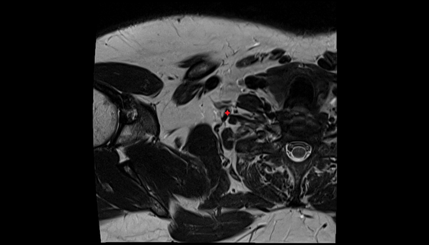Thyrocervical trunk anatomy MRI axial   image -img-00000-00000