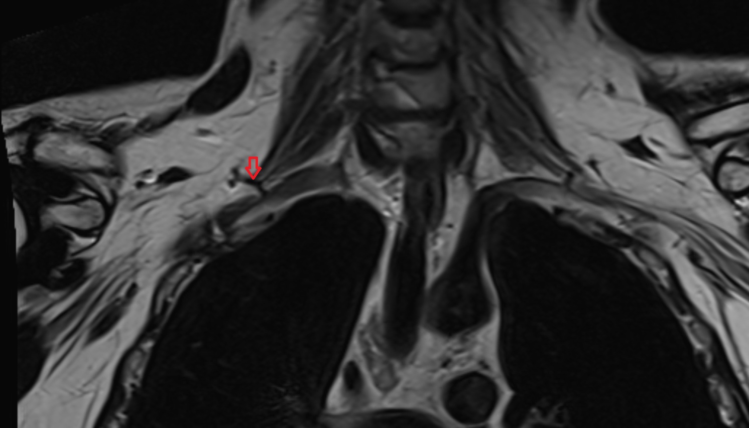 Thyrocervical trunk anatomy  MRI coronal  image -img-00000-00000