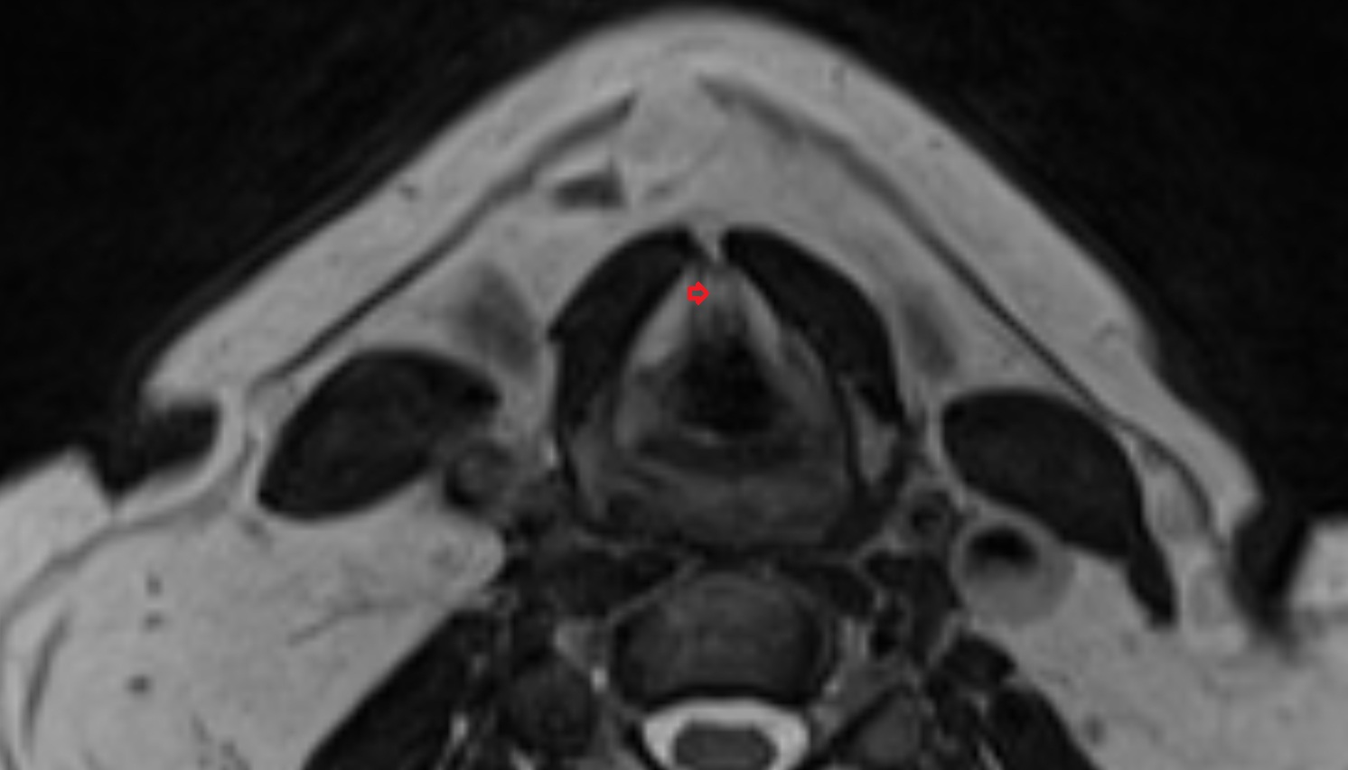 Thyroepiglottic ligament  mri axial image -img-00000-00000