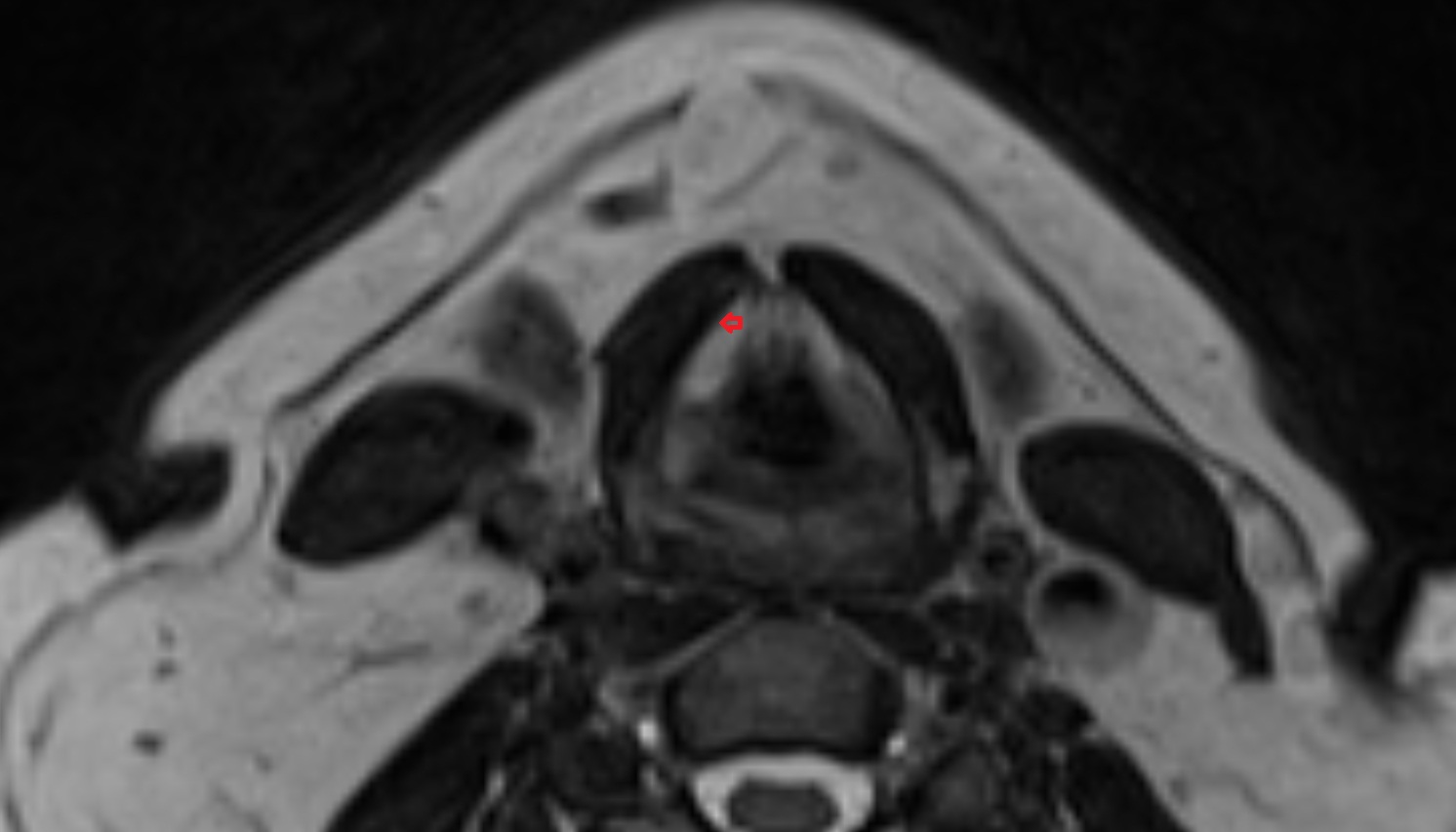 Thyrohyoid Membrane  mri axial image -img-00000-00000