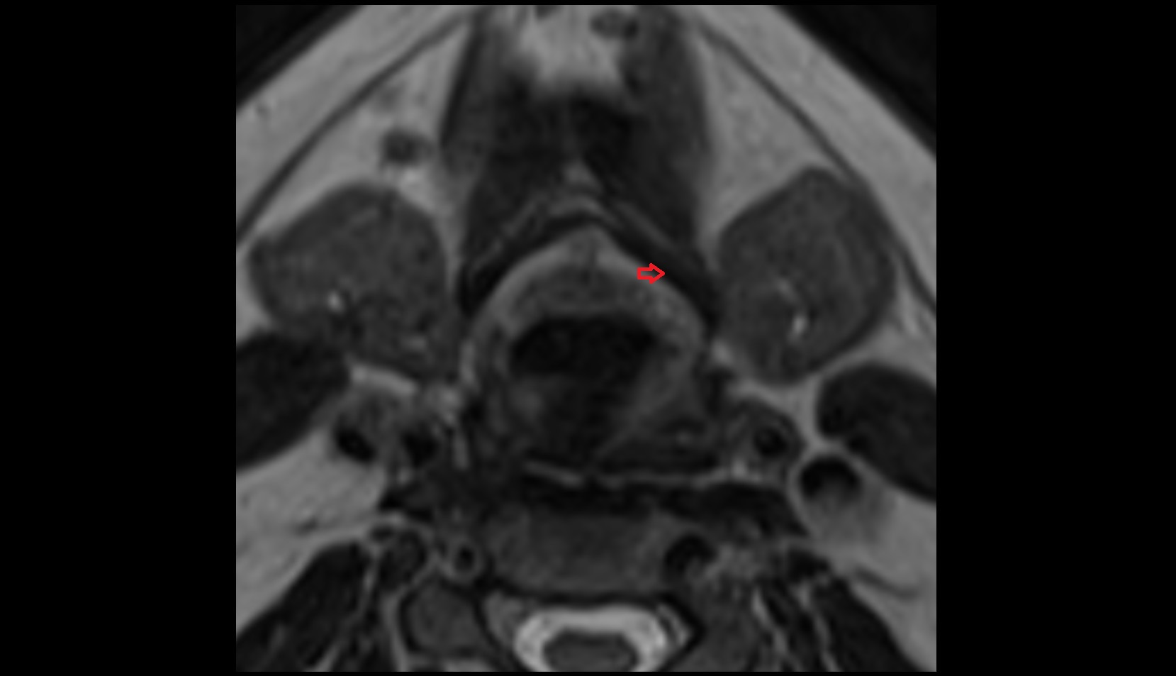 Thyrohyoid Muscle mri axial image