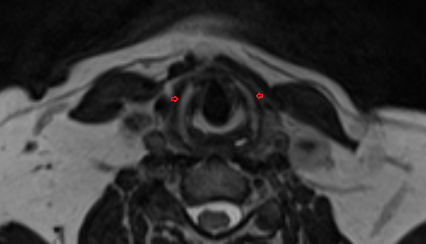 Thyroid cartilage  mri coronal image -img-00000-00000