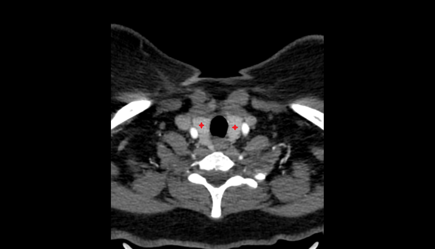 Thyroid gland CT axial  image-img-00000-00000