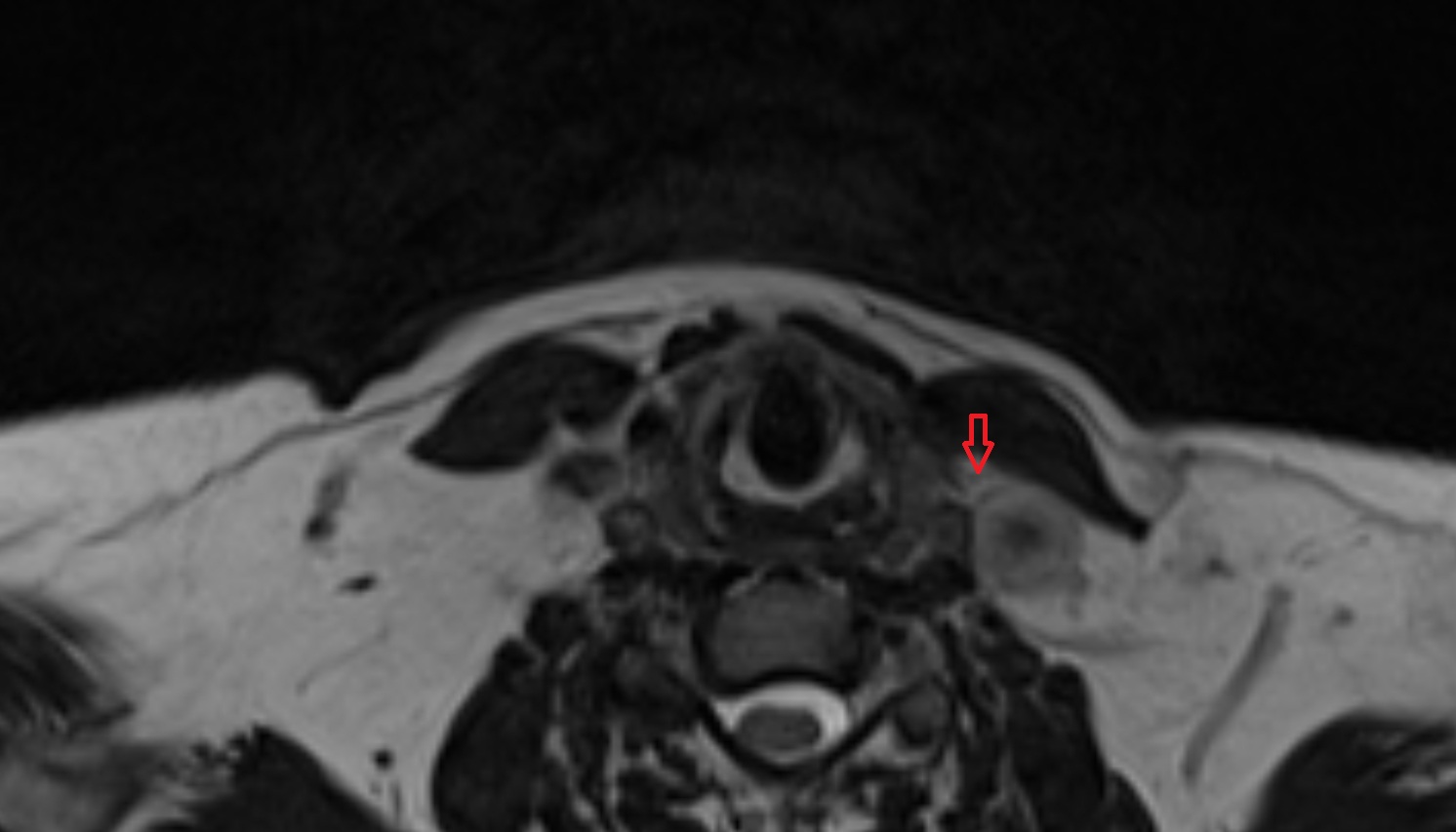 Thyroid lymph nodes  mri axial  image -img-00000-00000