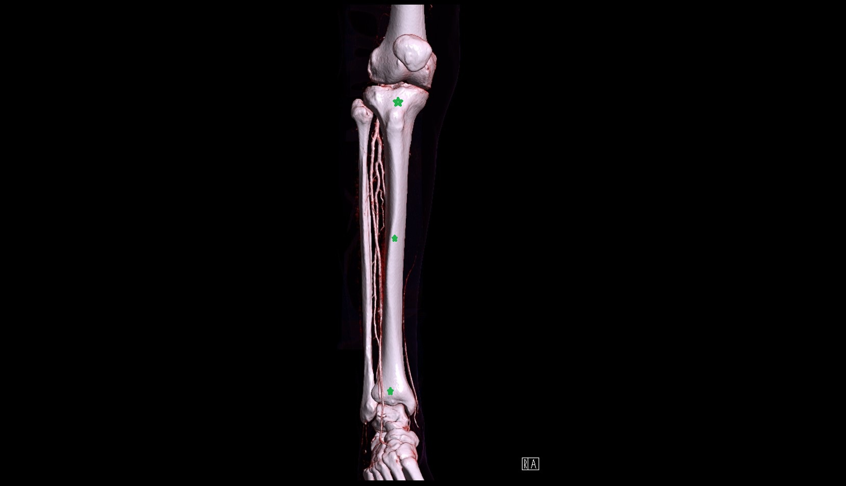 tibia 3d image