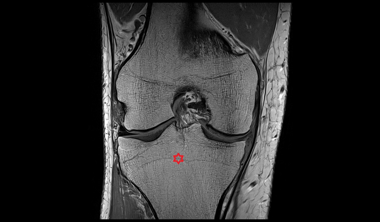 Tibia bone anatomy image