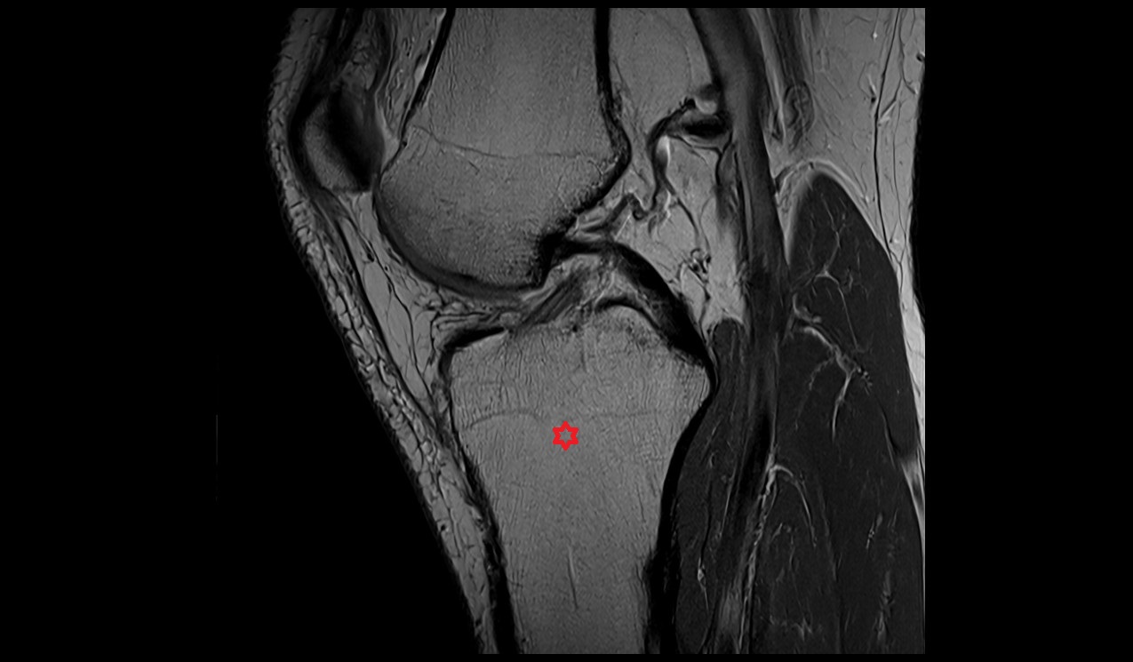 Tibia bone anatomy mri 3T