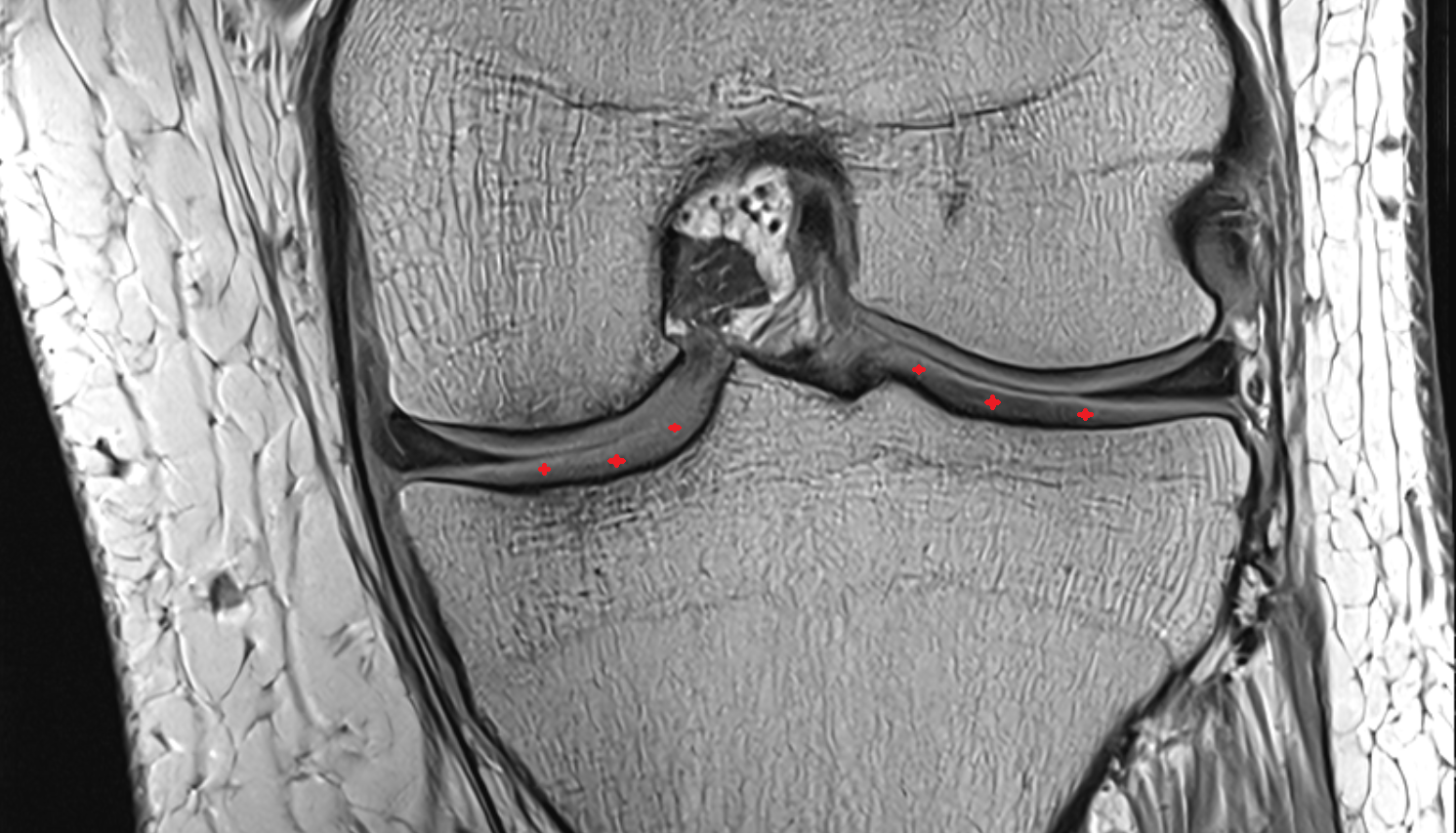 Tibial condyle articular cartilage coronall cross sectional anatomy 3T MRI AI enhanced  radiology  anatomy image-img-00000-00000
