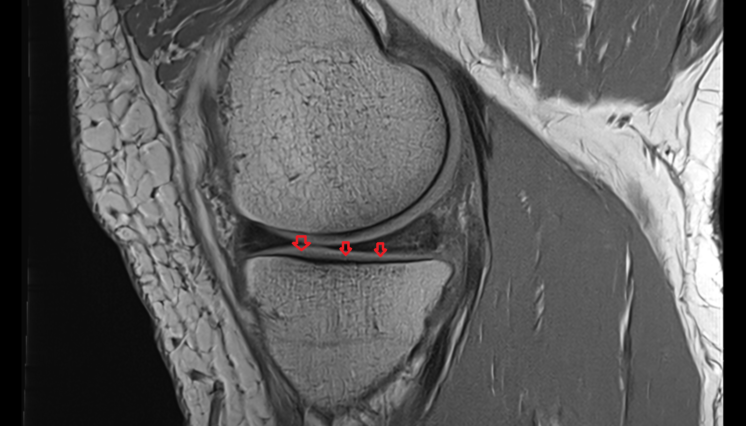 Tibial condyle articular cartilage sagittal cross sectional anatomy 3T MRI AI enhanced  radiology  anatomy image-img-00000-00000
