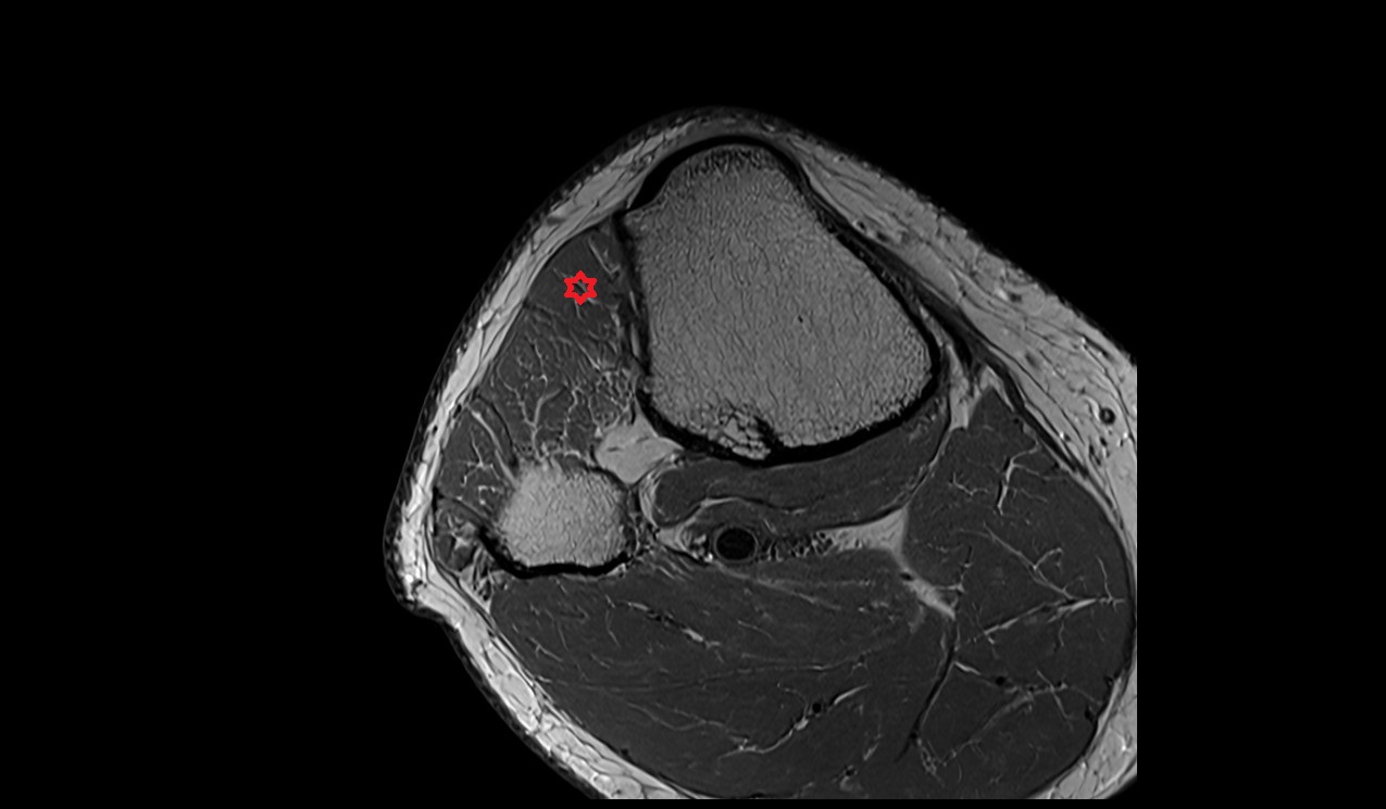 Tibialis anterior muscle anatomy