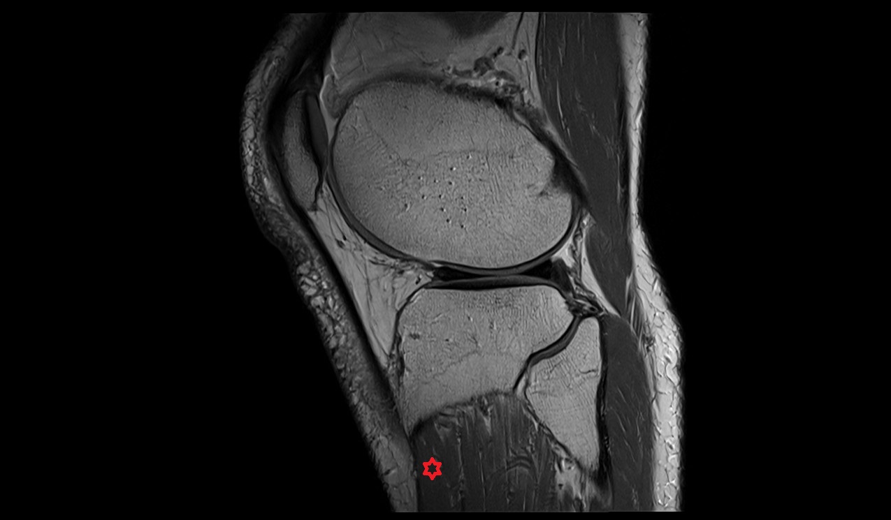 Tibialis anterior muscle anatomy 3t mri image