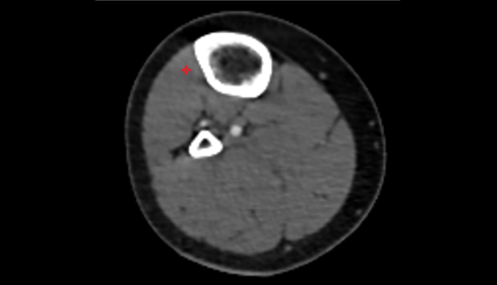 Tibialis anterior muscle axial ct image  0