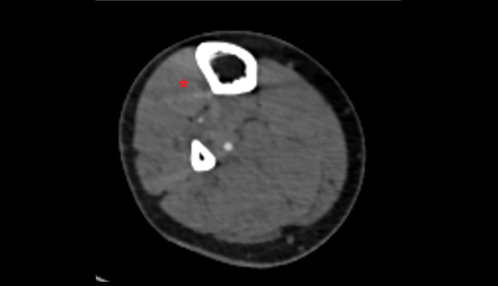Tibialis anterior muscle axial ct image  1