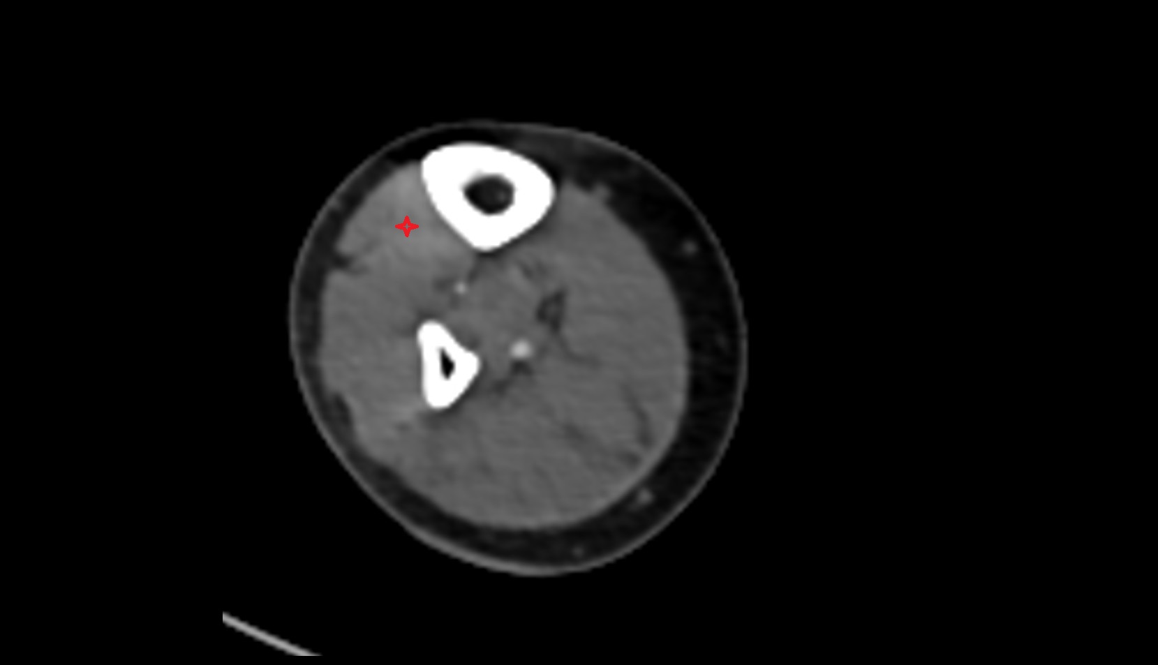 Tibialis anterior muscle axial ct image  2