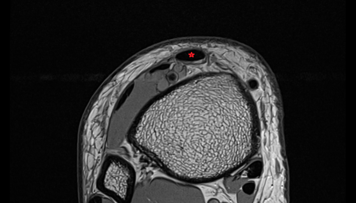 Tibialis anterior tendon  axial cross sectional anatomy 3T MRI AI enhanced radiology image-img-00000-00000_00001