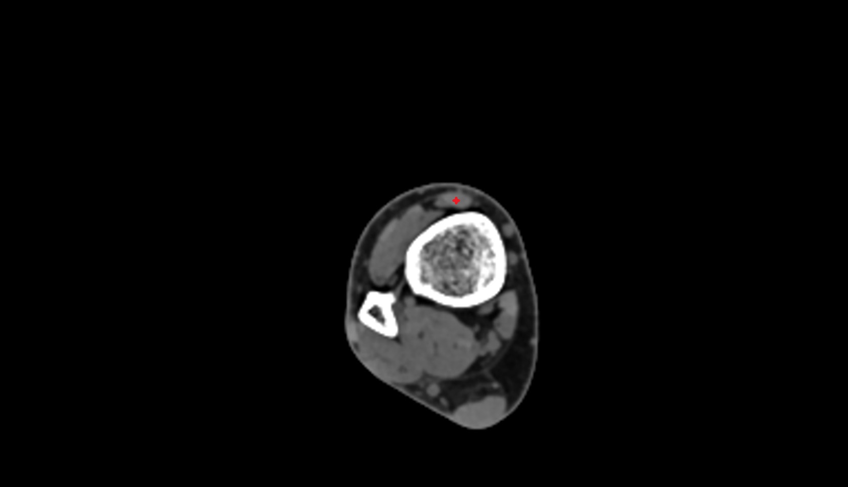 Tibialis anterior tendon ct axial