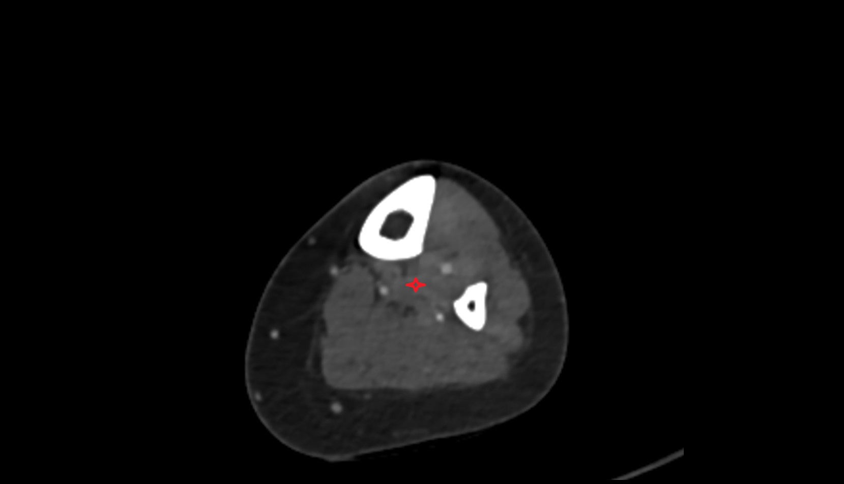 Tibialis posterior muscle 1