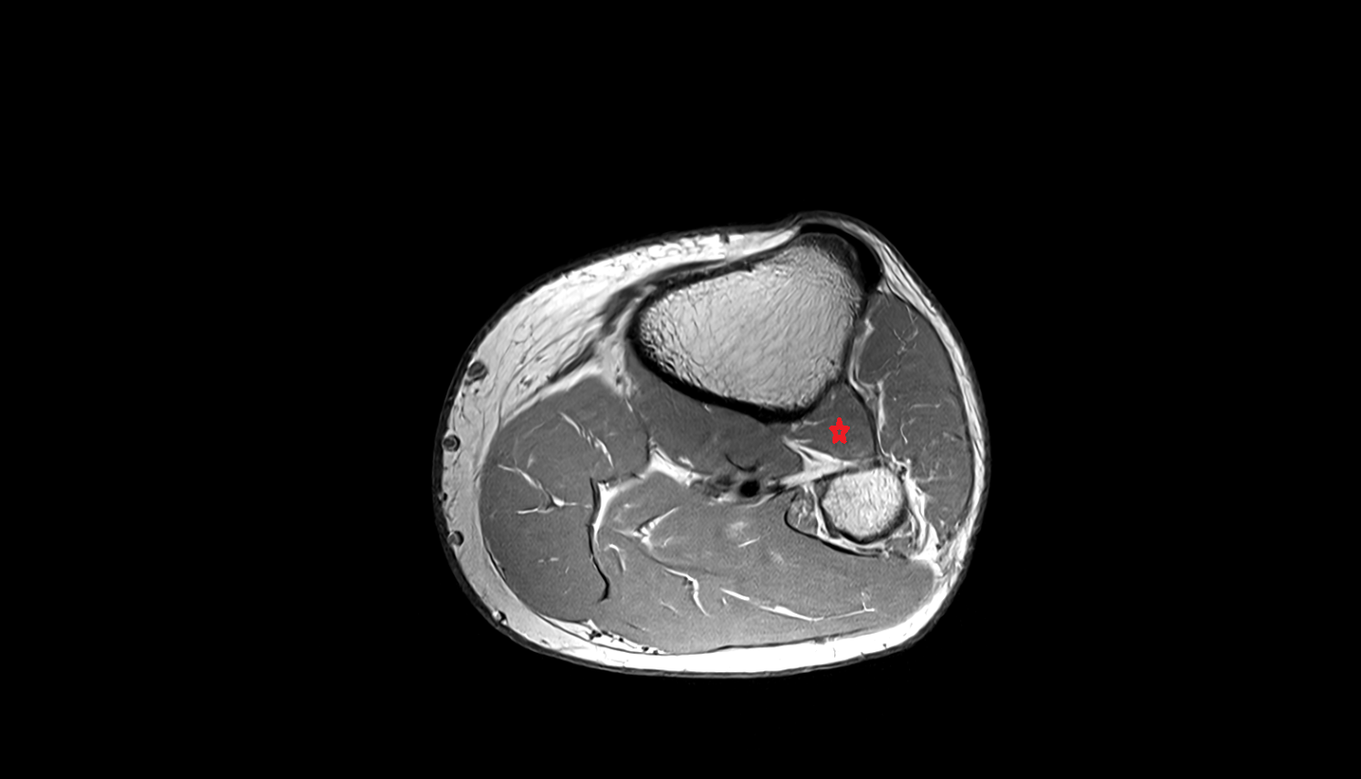 Tibialis posterior muscle axial  cross sectional anatomy 3T MRI AI enhanced radiology image-img-00000-00000