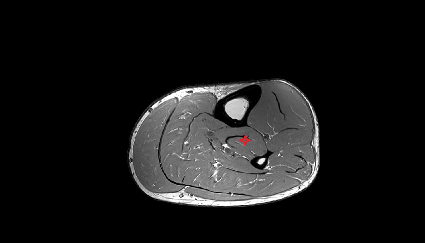 Tibialis posterior muscle axial  cross sectional anatomy 3T MRI AI enhanced radiology image-img-00000-00000_00001