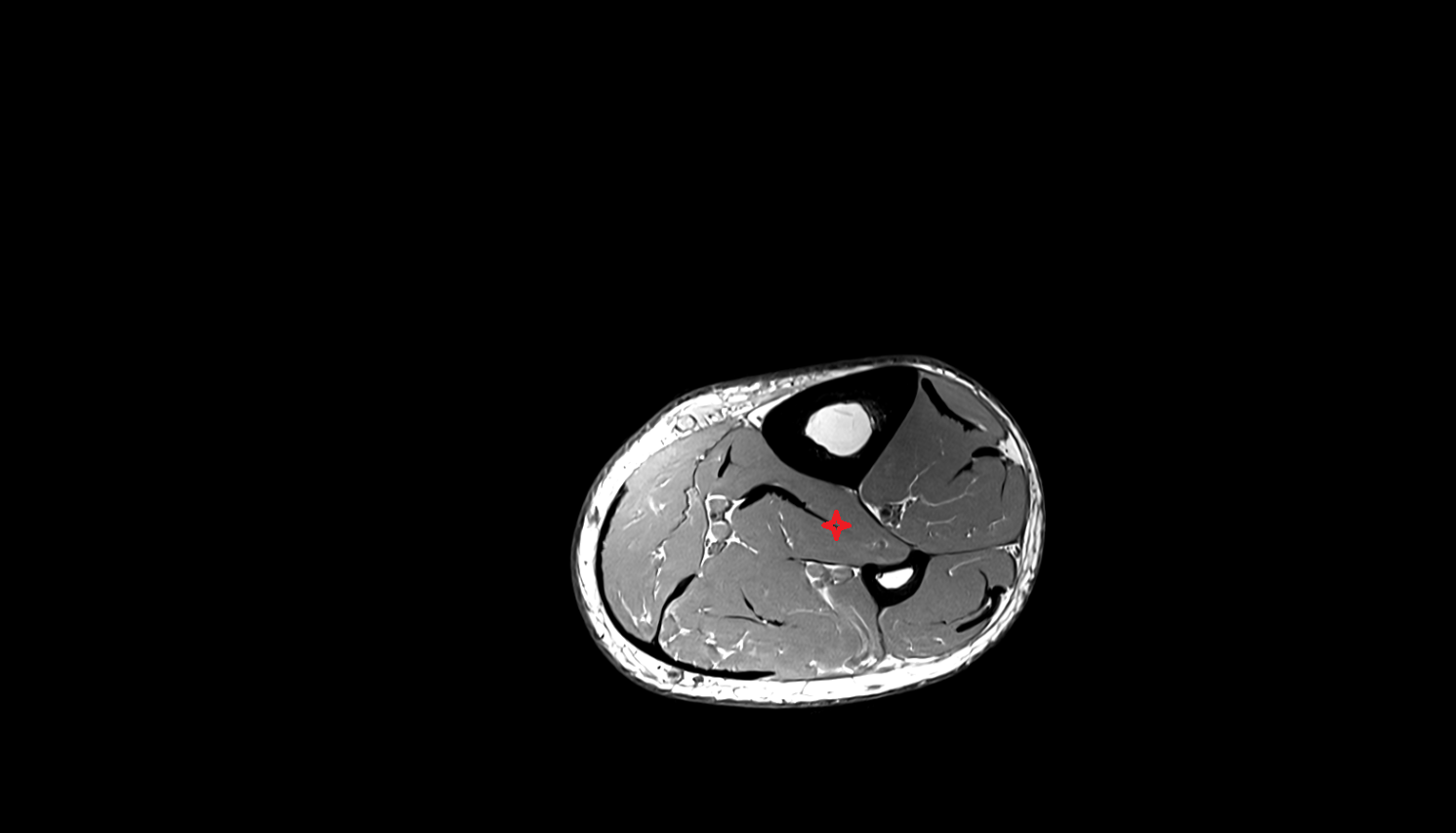 Tibialis posterior muscle axial  cross sectional anatomy 3T MRI AI enhanced radiology image-img-00000-00000_00002