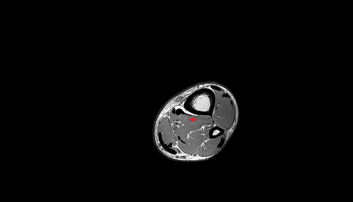Tibialis posterior muscle axial  cross sectional anatomy 3T MRI AI enhanced radiology image-img-00000-00000_00003