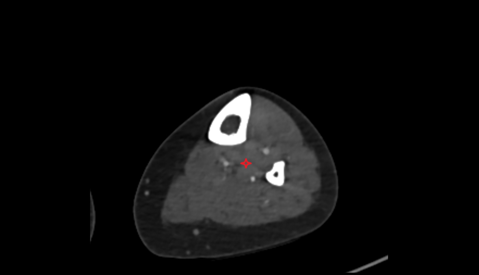 Tibialis posterior muscle ct axial