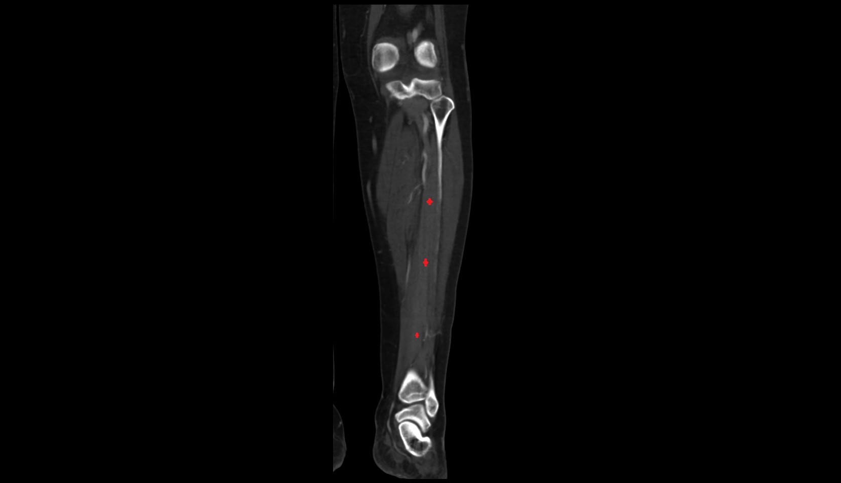 Tibialis posterior muscle ct coronal