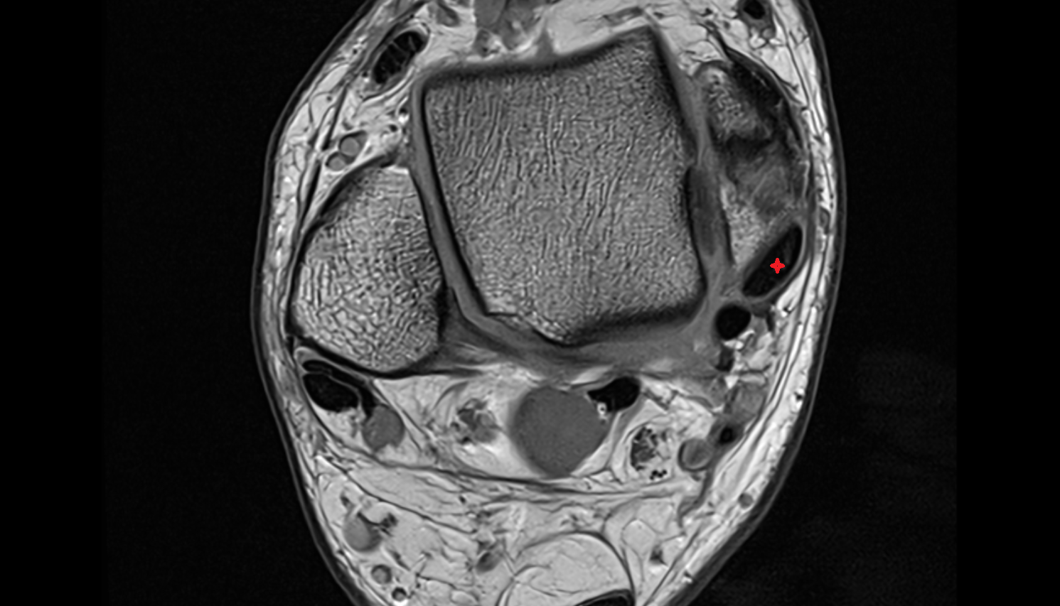 Tibialis posterior tendon axial cross sectional anatomy 3T MRI AI enhanced radiology image-img-00000-00000_00001