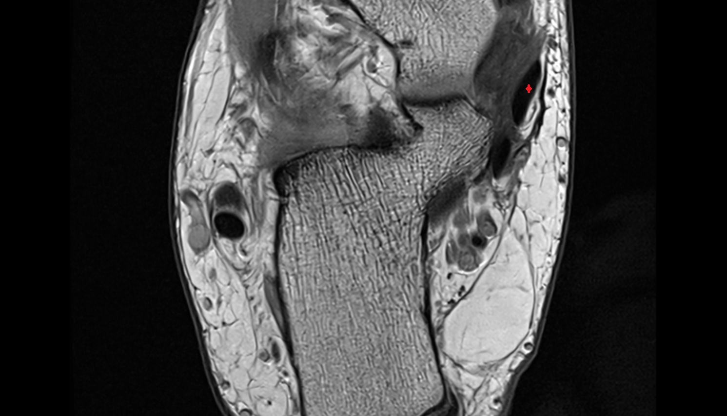 Tibialis posterior tendon axial cross sectional anatomy 3T MRI AI enhanced radiology image-img-00000-00000_00002
